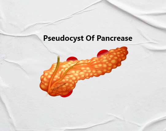 Pseudocyst Of Pancrease